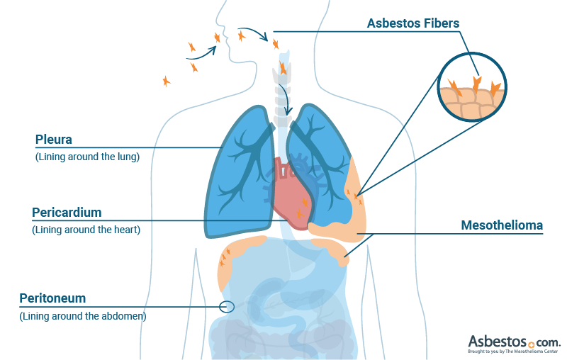 Effects of Asbestos Diagram